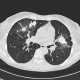 Wegener's granulomatosis, development in time, year four: CT - Computed tomography
